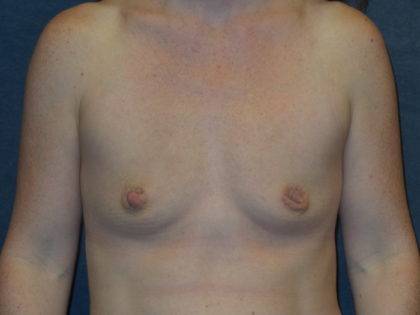 Breast Augmentation Before & After Patient #2799