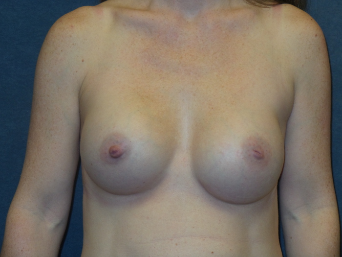 Breast Augmentation Before & After Patient #2799