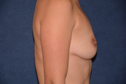 Breast Augmentation Before & After Patient #2806