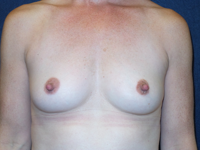 Breast Augmentation Before & After Patient #2778