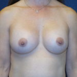Breast Augmentation Before & After Patient #2778