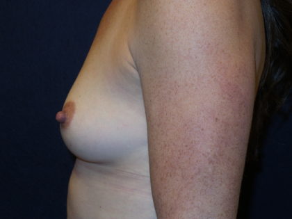 Breast Augmentation Before & After Patient #2778