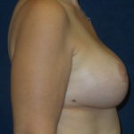 Breast Augmentation Before & After Patient #2785