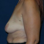 Breast Augmentation Before & After Patient #2785