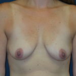 Breast Augmentation Before & After Patient #2909