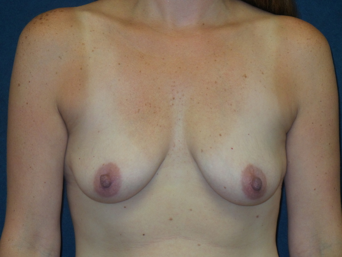 Breast Augmentation Before & After Patient #2909
