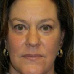 Facelift Before & After Patient #2936