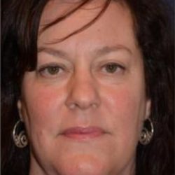 Facelift Before & After Patient #2936