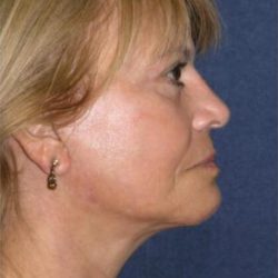 Blepharoplasty Before & After Patient #2933