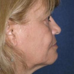 Blepharoplasty Before & After Patient #2933