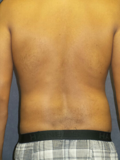 Liposuction Before & After Patient #2959