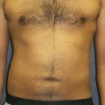 Liposuction Before & After Patient #2959