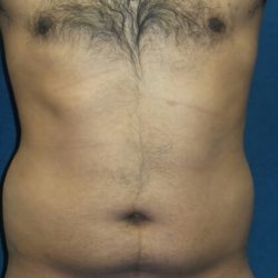 Liposuction Before & After Patient #2959