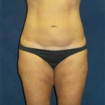 Liposuction Before & After Patient #2951
