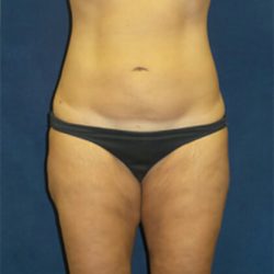 Liposuction Before & After Patient #2951
