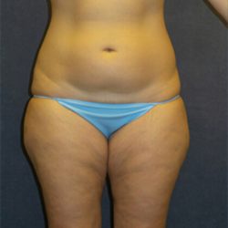 Liposuction Before & After Patient #2951