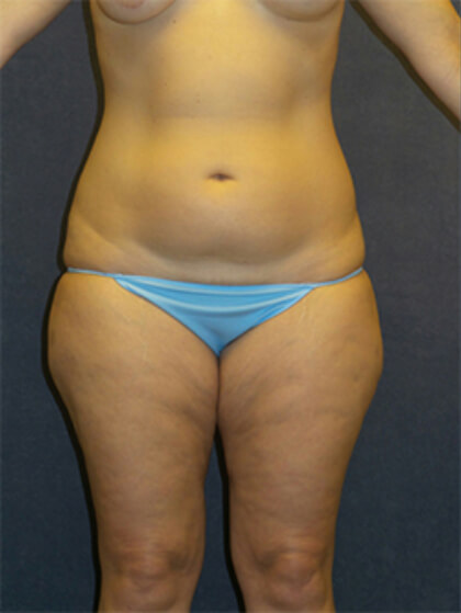Liposuction Before & After Patient #2951