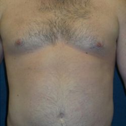 Liposuction Before & After Patient #2946