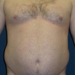 Liposuction Before & After Patient #2946