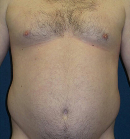 Liposuction Before & After Patient #2946