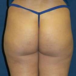 Cellfina Before & After Patient #2964