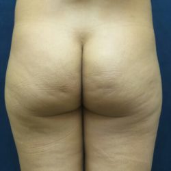 Cellfina Before & After Patient #2964