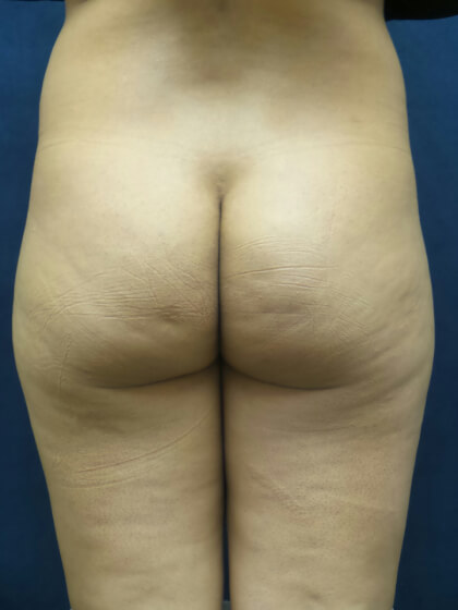 Cellfina Before & After Patient #2964