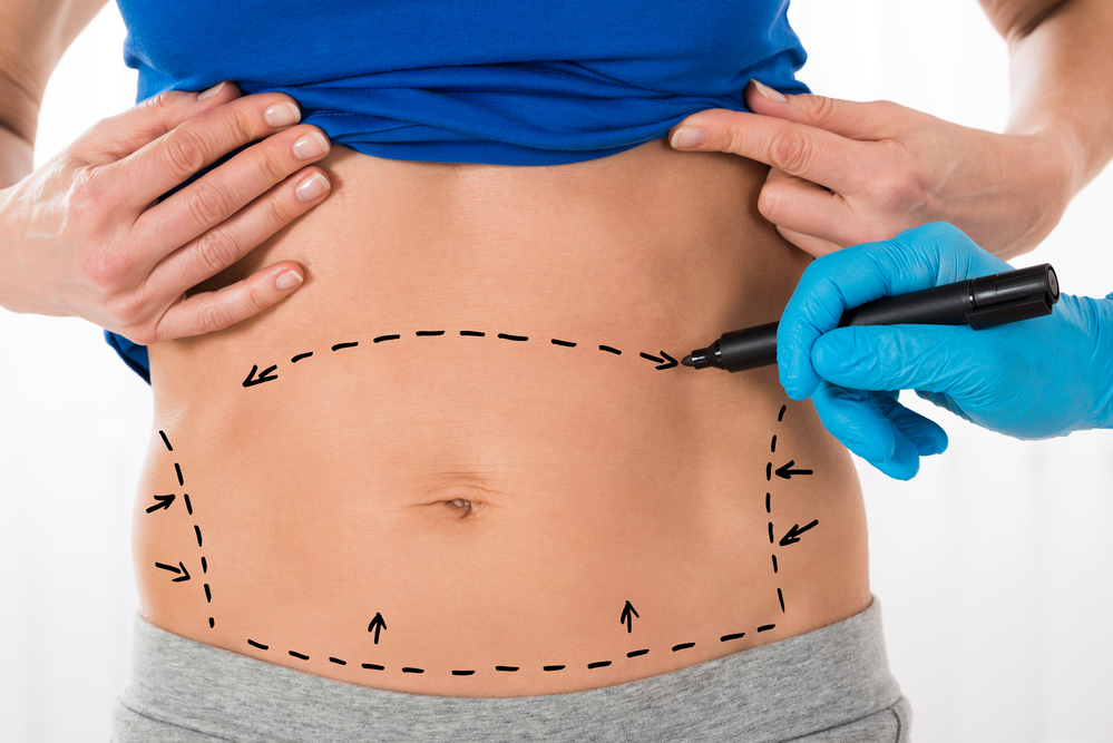 How Much Fat Can You Lose With a Tummy Tuck? - Bachelor, Eric (ericpbachelormd.com)