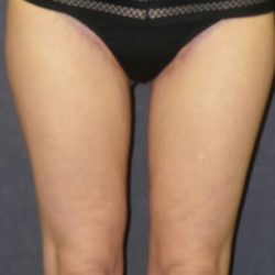 Liposuction Before & After Patient #2956