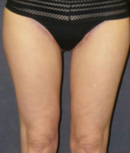 Liposuction Before & After Patient #2956