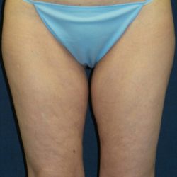 Liposuction Before & After Patient #2956