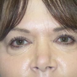 Blepharoplasty Before & After Patient #2943