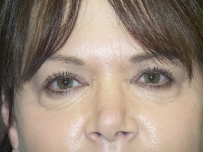 Blepharoplasty Before & After Patient #2943