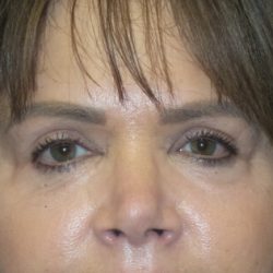 Blepharoplasty Before & After Patient #2943