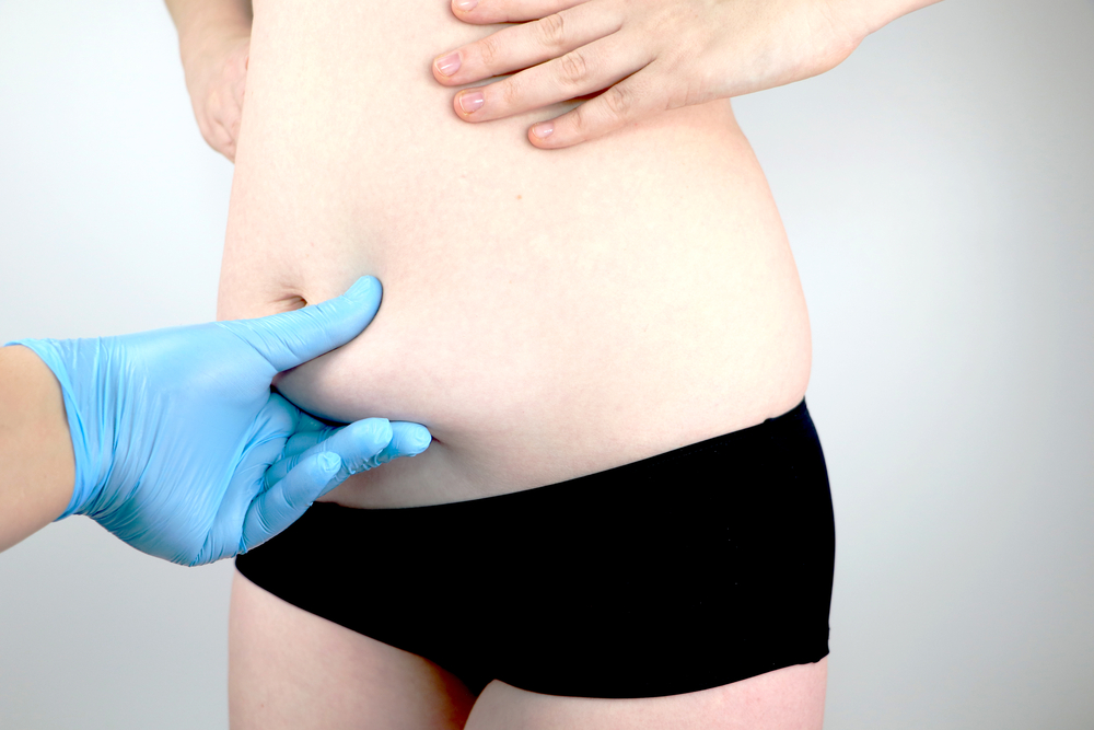 How a Tummy Tuck Can Help Improve Bladder Control