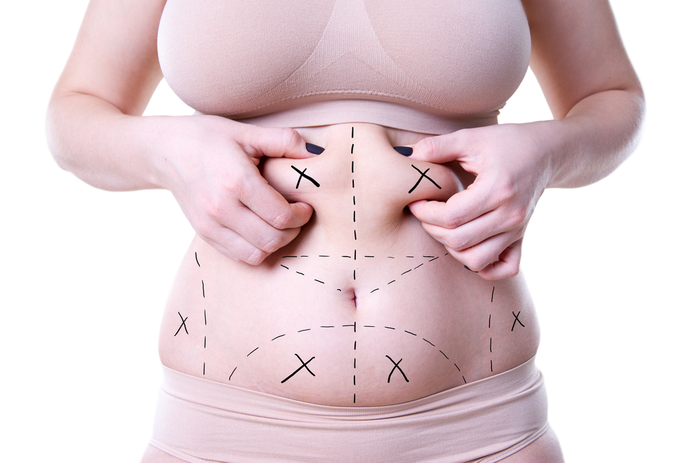 Tummy Tuck - Who is a good candidate? Body Contouring