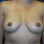 Breast Lift Before & After Patient #2926