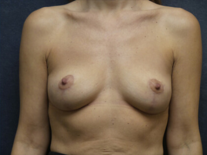 Breast Lift Before & After Patient #2923