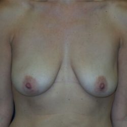 Breast Lift Before & After Patient #2923
