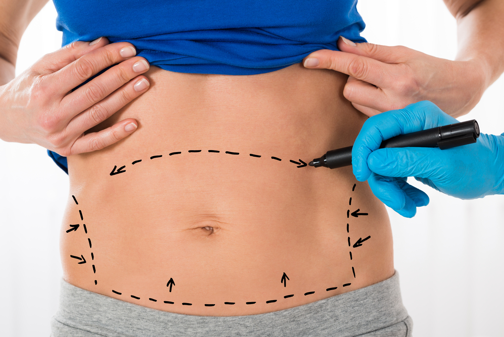How Long Is Recovery After a Tummy Tuck? - Bachelor, Eric