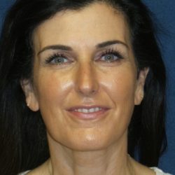 Neck Lift Before & After Patient #3316