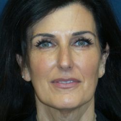 Neck Lift Before & After Patient #3316