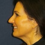 Neck Lift Before & After Patient #3316