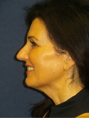 Neck Lift Before & After Patient #3316