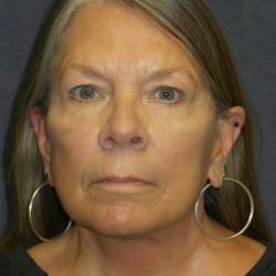 Facelift Before & After Patient #3311