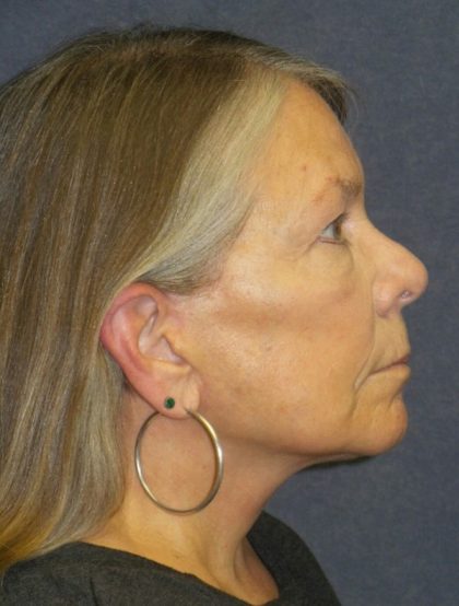 Facelift Before & After Patient #3311