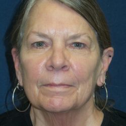 Facelift Before & After Patient #3311