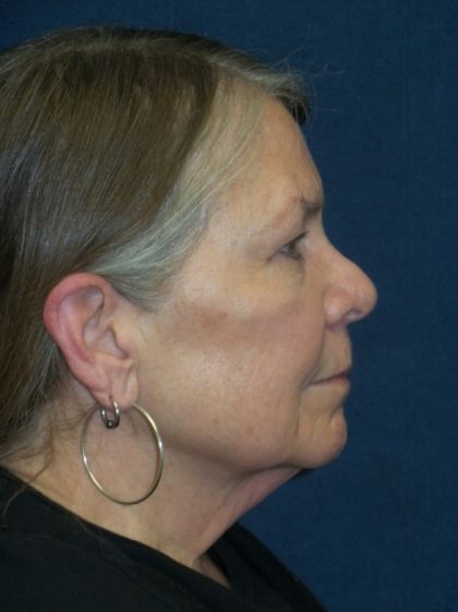 Facelift Before & After Patient #3311