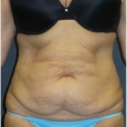 Tummy Tuck Before & After Patient #3401