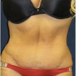Tummy Tuck Before & After Patient #3401